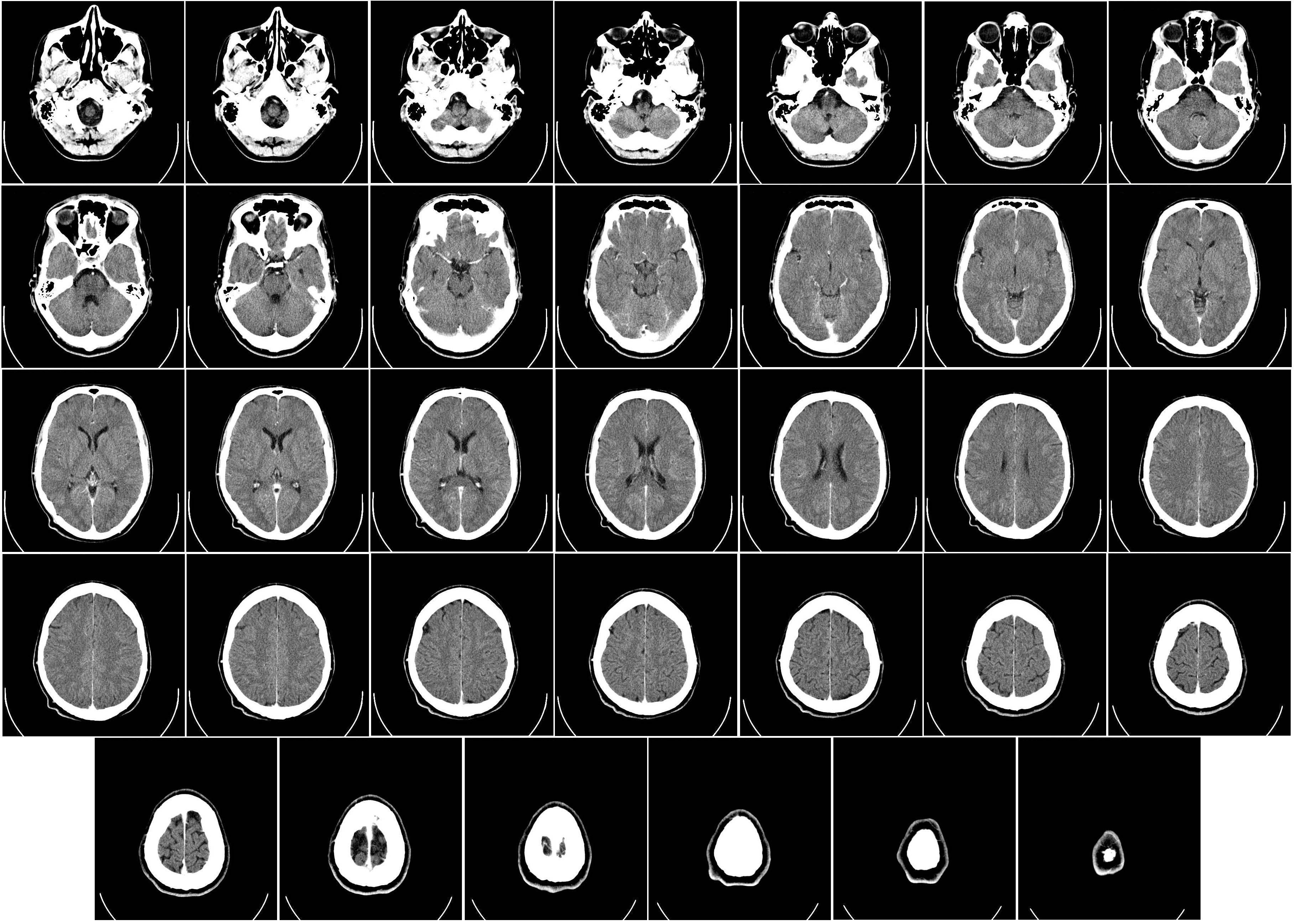 CT brain scan — stroke and neuroimaging classification
